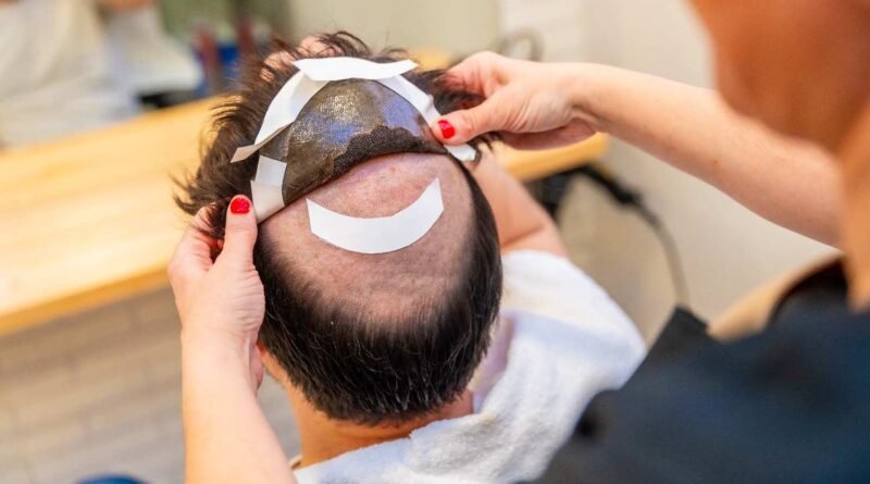 7 Latest Hair Transplant Technology in 2024